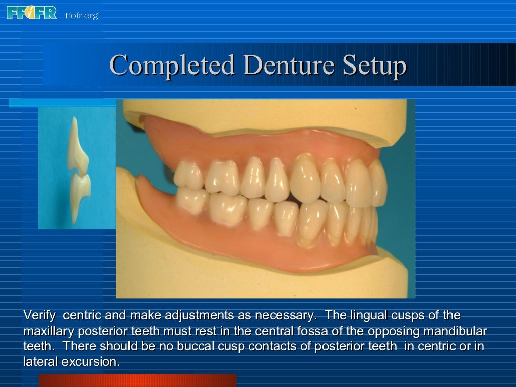 16.occlusal schemes lingualized occlusion