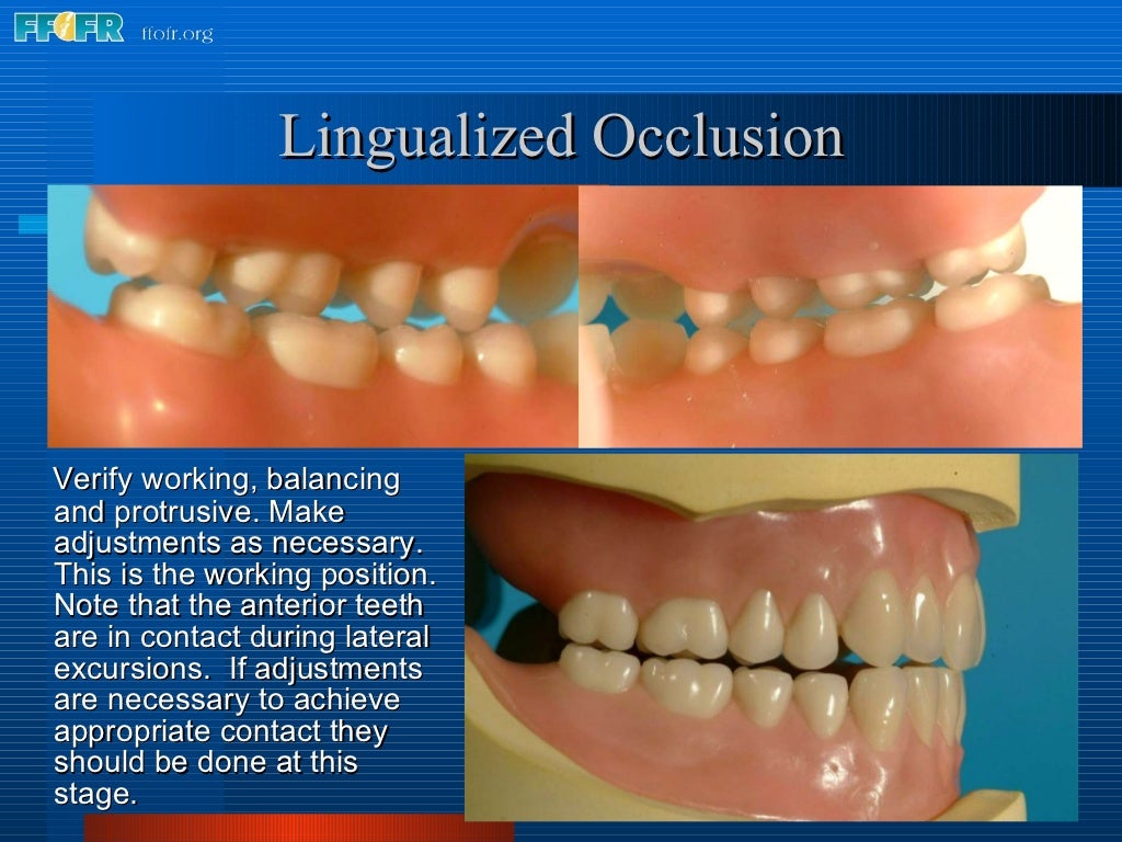16 occlusal schemes lingualized occlusion