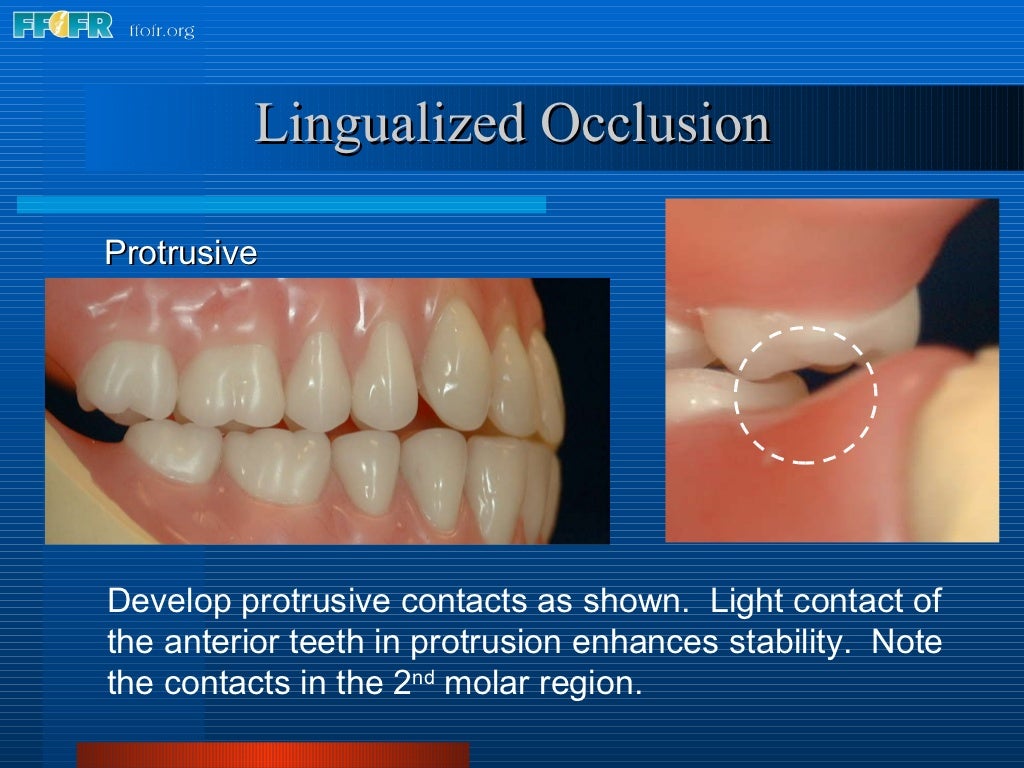 16.occlusal schemes lingualized occlusion