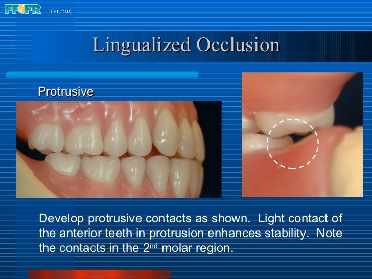 16.occlusal schemes lingualized occlusion