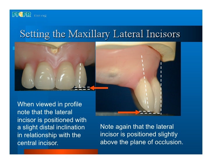 16.occlusal schemes lingualized occlusion