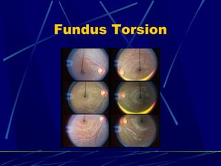 Fundus Torsion
 