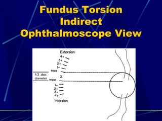 Fundus Torsion
Indirect
Ophthalmoscope View
 
