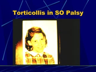 Torticollis in SO Palsy
 