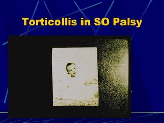 Torticollis in SO Palsy
 