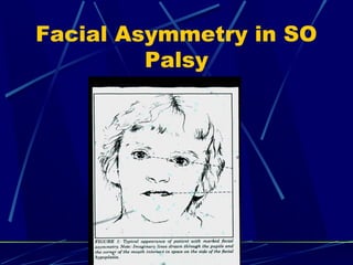 Facial Asymmetry in SO
Palsy
 