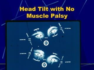 Head Tilt with No
Muscle Palsy
 