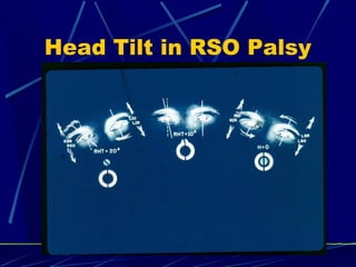 Head Tilt in RSO Palsy
 