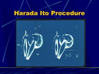 Harada Ito Procedure
 