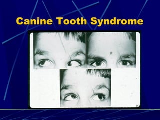 Canine Tooth Syndrome
 
