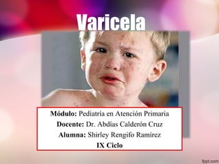 Varicela
Módulo: Pediatría en Atención Primaria
Docente: Dr. Abdías Calderón Cruz
Alumna: Shirley Rengifo Ramírez
IX Ciclo
 