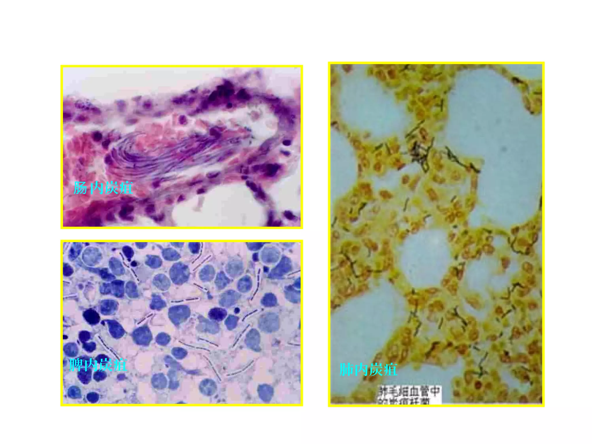 肺内炭疽
内炭疽肠
脾内炭疽
 