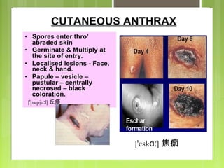 ['pæpju l]ː 丘疹
['esk ]ɑː 焦痂
 