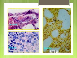 肺内炭疽
内炭疽肠
脾内炭疽
 