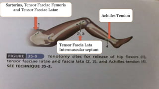 Sartorius, Tensor Fasciae Femoris
and Tensor Fasciae Latae
Tensor Fascia Lata
Intermuscular septum
Achilles Tendon
 