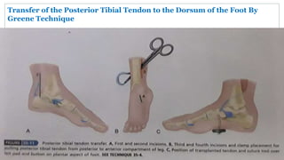 Transfer of the Posterior Tibial Tendon to the Dorsum of the Foot By
Greene Technique
 