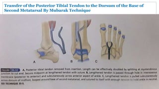 Transfer of the Posterior Tibial Tendon to the Dorsum of the Base of
Second Metatarsal By Mubarak Technique
 