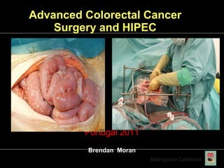 Advanced Colorectal Cancer  Surgery and HIPEC  ,[object Object],[object Object]