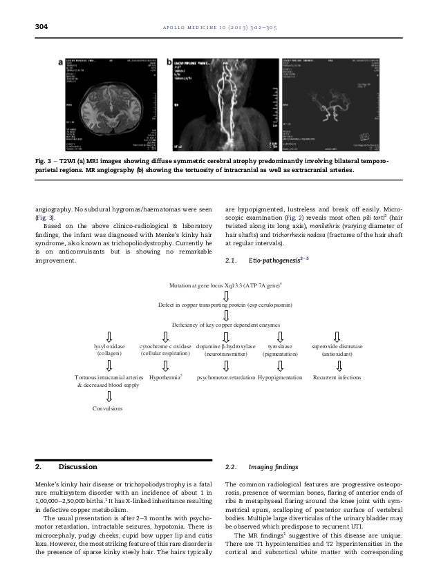 Menke S Kinky Hair Syndrome A Spectrum Of Clinico Radiological Find