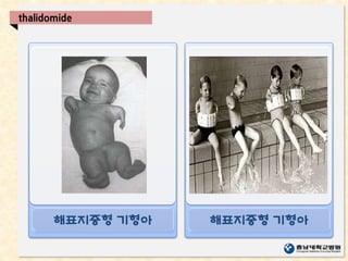 해표지증형 기형아 해표지증형 기형아
thalidomide
 