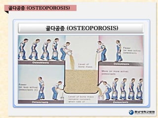 골다공증 (OSTEOPOROSIS)
골다공증 (OSTEOPOROSIS)
 