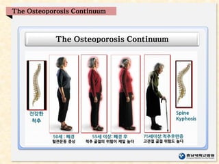 The Osteoporosis Continuum
The Osteoporosis Continuum
 