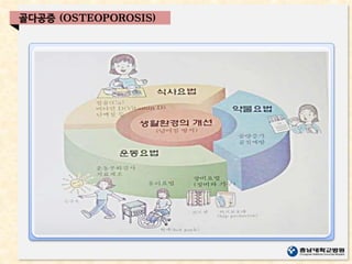 골다공증 (OSTEOPOROSIS)
 