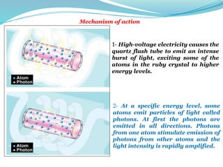 1- High-voltage electricity causes the
quartz flash tube to emit an intense
burst of light, exciting some of the
atoms in the ruby crystal to higher
energy levels.
2- At a specific energy level, some
atoms emit particles of light called
photons. At first the photons are
emitted in all directions. Photons
from one atom stimulate emission of
photons from other atoms and the
light intensity is rapidly amplified.
Mechanism of action
 