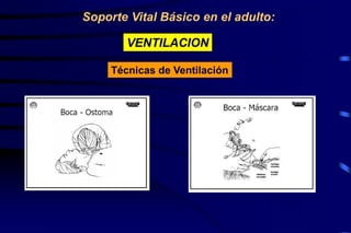 Soporte Vital Básico en el adulto:
VENTILACION
Técnicas de Ventilación
 