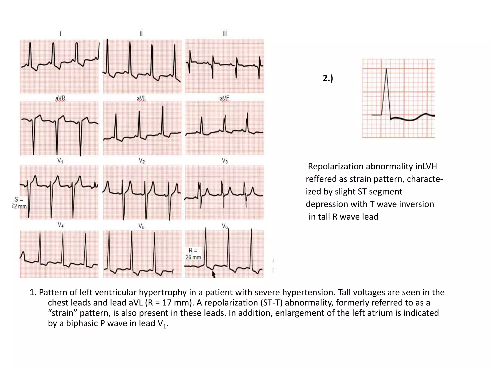cases of ecg interpretation | PPTX