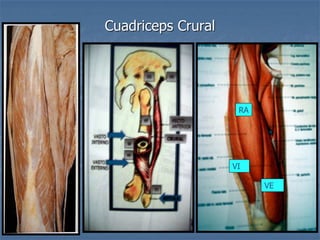 Cuadriceps Crural
RA
VI
VE
 