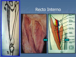 Recto Interno
 