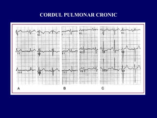 CORDUL PULMONAR CRONIC
 