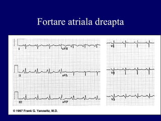 Fortare atriala dreapta
 