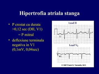 Hipertrofia atriala stanga
• P crestat cu durata
>0,12 sec (DII, V1)
= P mitral
• deflexiune terminala
negativa in V1
(0,1mV, 0,04sec)
 