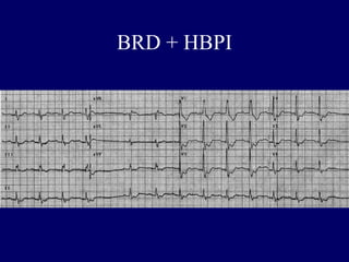 BRD + HBPI
 