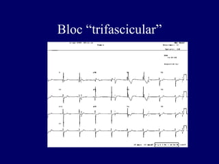 Bloc “trifascicular”
 