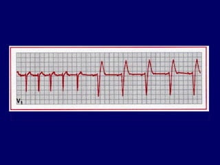16174062-ECG-hipertrofii.pdf