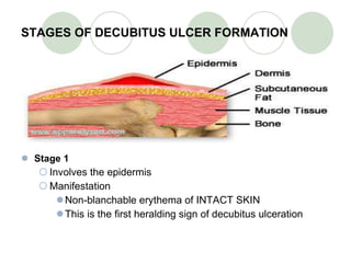 STAGES OF DECUBITUS ULCER FORMATION Stage 1 Involves the epidermis Manifestation Non-blanchable erythema of INTACT SKIN This is the first heralding sign of decubitus ulceration 