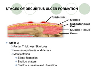 STAGES OF DECUBITUS ULCER FORMATION Stage 2 Partial Thickness Skin Loss Involves epidermis and dermis Manifestation Blister formation Shallow craters Shallow abrasion and ulceration 