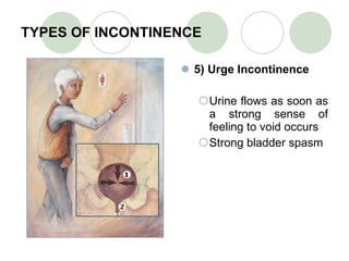TYPES OF INCONTINENCE 5) Urge Incontinence Urine flows as soon as a strong sense of feeling to void occurs Strong bladder spasm 