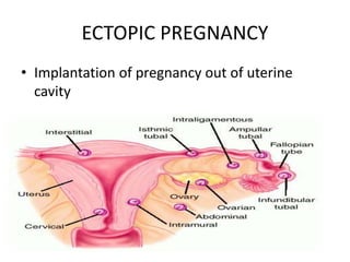ECTOPIC PREGNANCY
• Implantation of pregnancy out of uterine
cavity
 