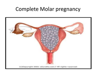 Complete Molar pregnancy
 