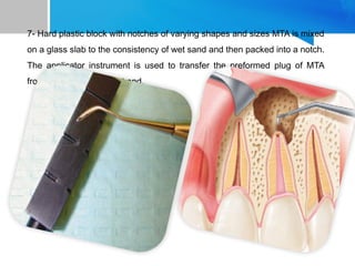 7- Hard plastic block with notches of varying shapes and sizes MTA is mixed
on a glass slab to the consistency of wet sand and then packed into a notch.
The applicator instrument is used to transfer the preformed plug of MTA
from the block to the root end.
 