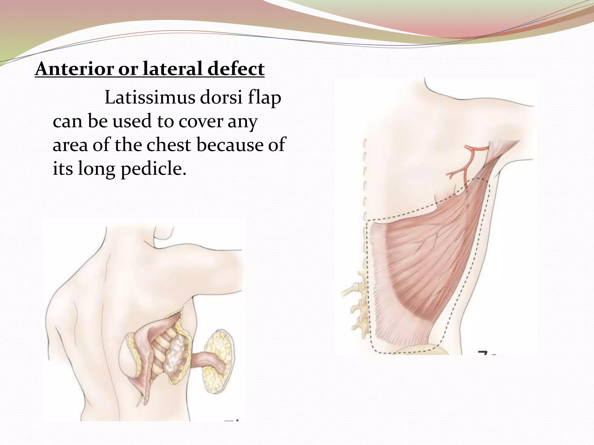 CHEST WALL TUMOR AND ITS MANAGEMENT | PPTX
