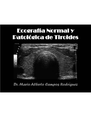 Ecografía Normal y Patológica Tiroides