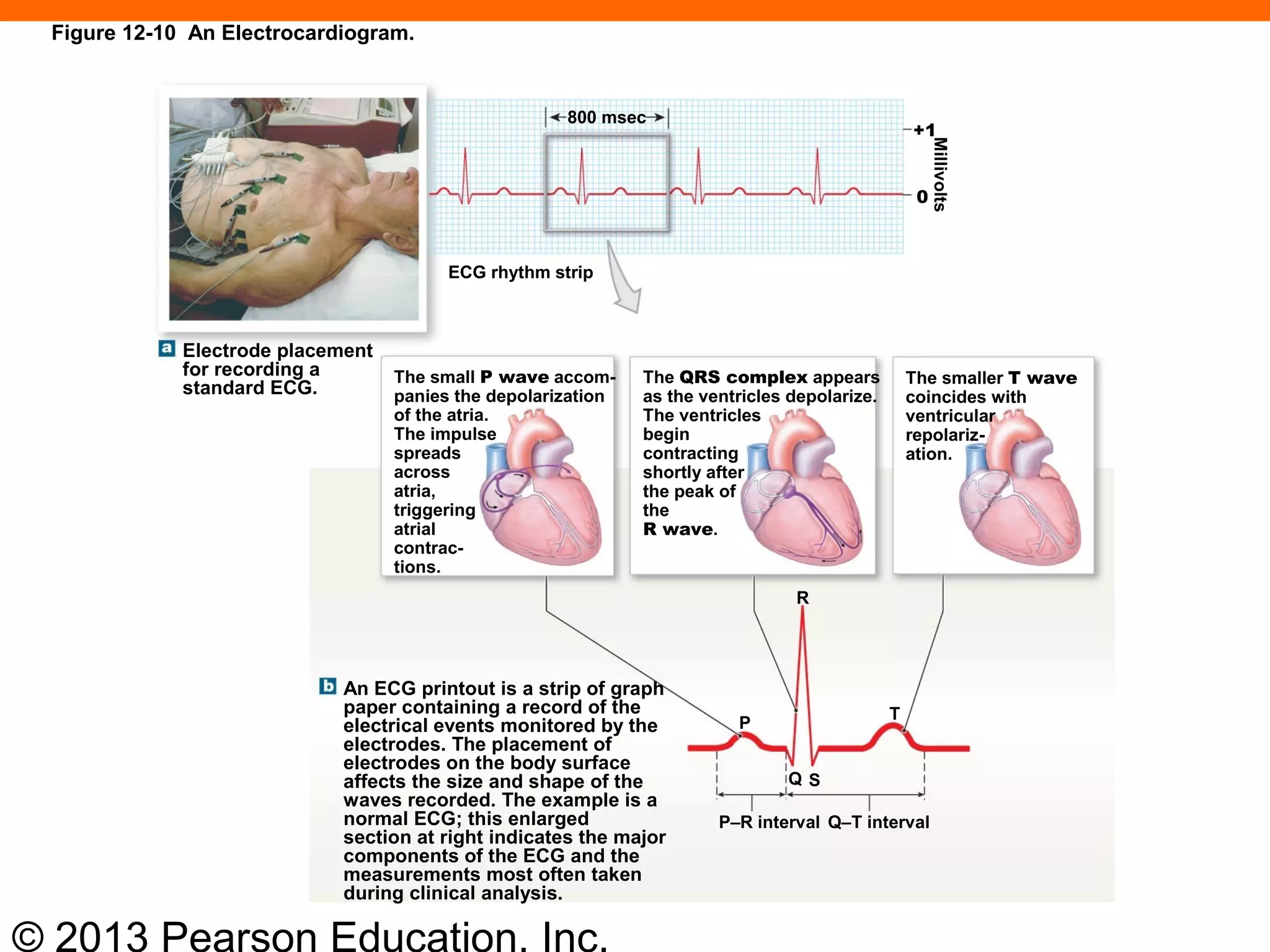 © 2013 Pearson Education, Inc.
Electrode placement
for recording a
standard ECG.
ECG rhythm strip
800 msec
Millivolts
+1
0
The small P wave accom-
panies the depolarization
of the atria.
The impulse
spreads
across
atria,
triggering
atrial
contrac-
tions.
The QRS complex appears
as the ventricles depolarize.
The ventricles
begin
contracting
shortly after
the peak of
the
R wave.
The smaller T wave
coincides with
ventricular
repolariz-
ation.
An ECG printout is a strip of graph
paper containing a record of the
electrical events monitored by the
electrodes. The placement of
electrodes on the body surface
affects the size and shape of the
waves recorded. The example is a
normal ECG; this enlarged
section at right indicates the major
components of the ECG and the
measurements most often taken
during clinical analysis.
P–R interval Q–T interval
R
P
Q S
T
Figure 12-10 An Electrocardiogram.
 