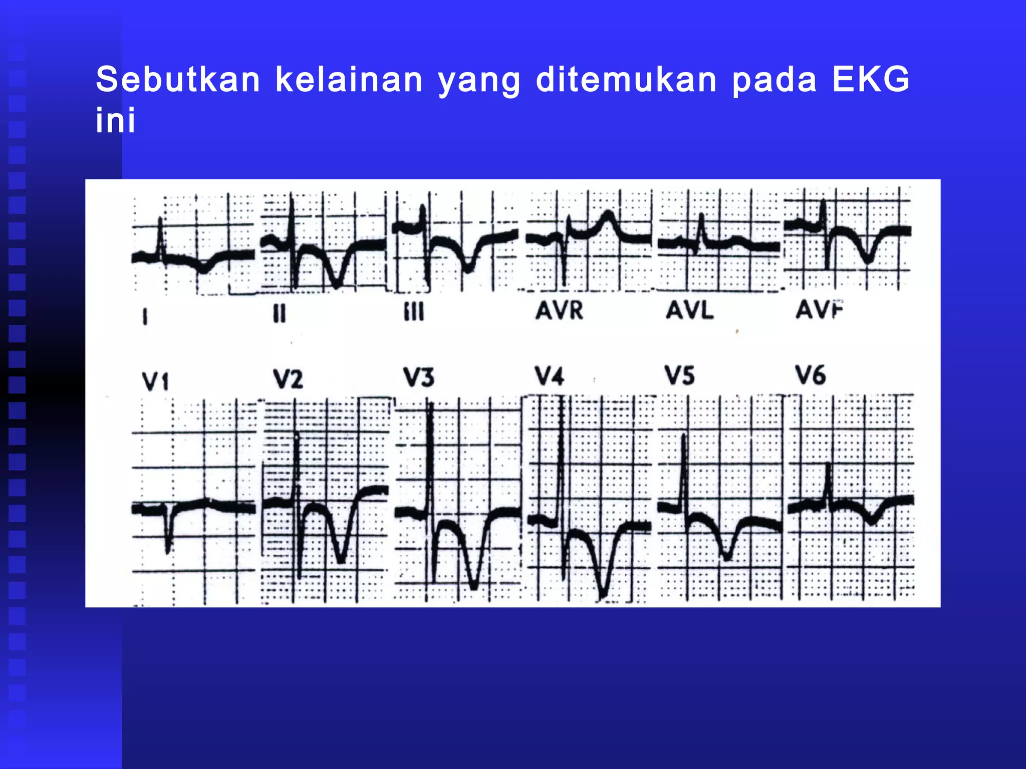 Sebutkan kelainan yang ditemukan pada EKG
ini
 