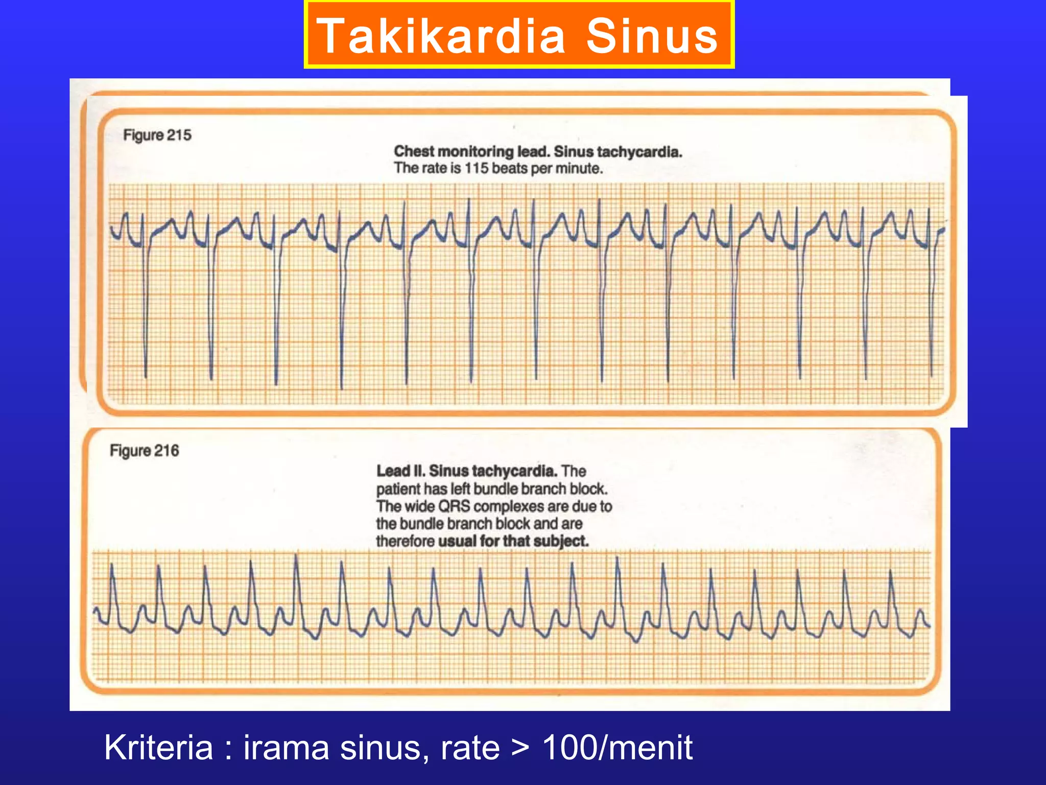 Takikardia Sinus
Kriteria : irama sinus, rate > 100/menit
 