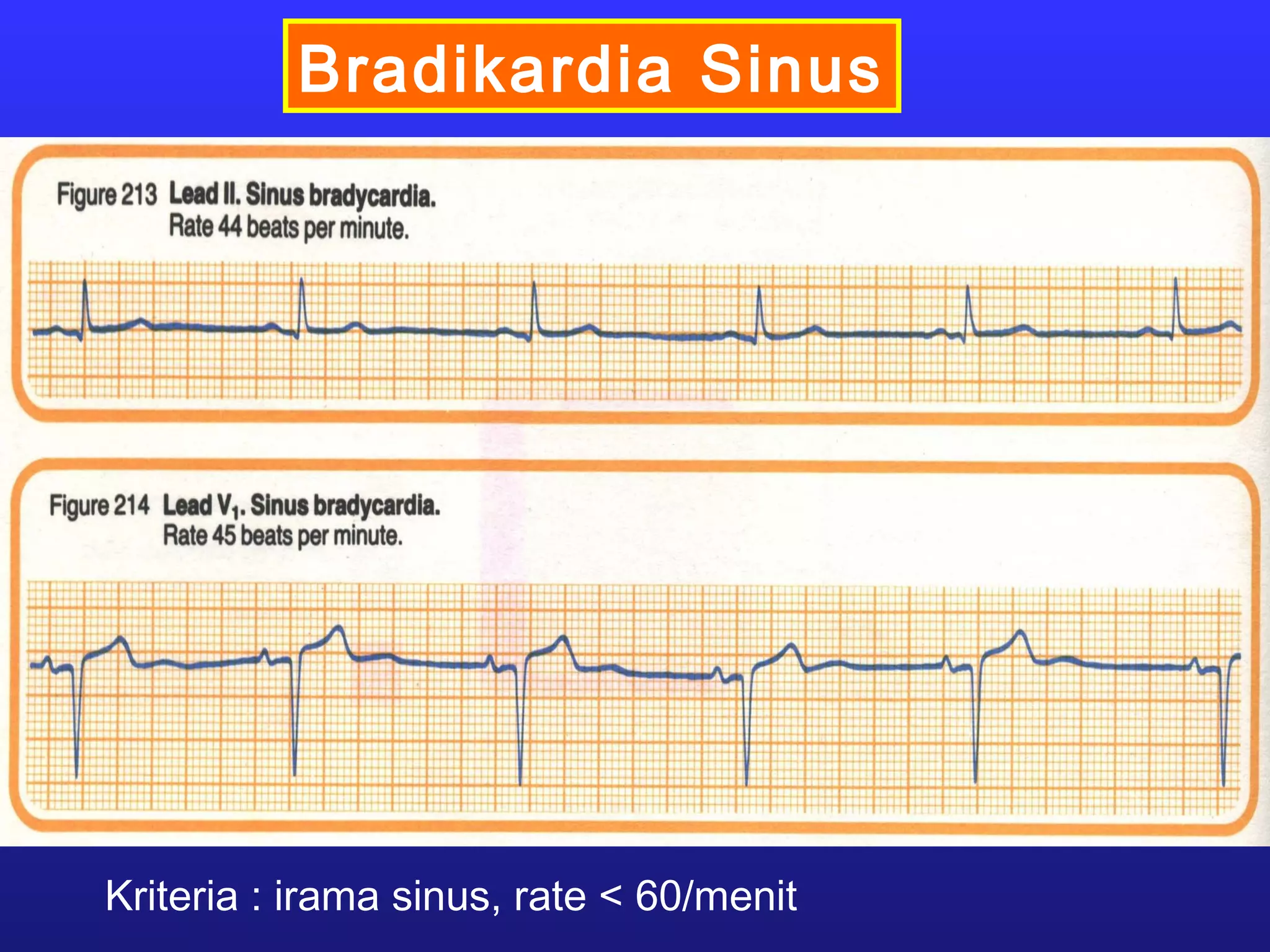 Bradikardia Sinus
Kriteria : irama sinus, rate < 60/menit
 